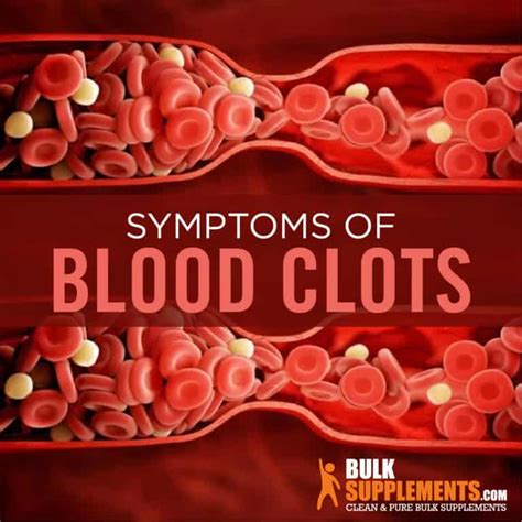 Blood Clots Symptoms, Causes and Treatment