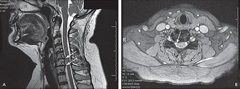 Cervical Radiculopathy: Nonoperative Management of Neck Pain and ...