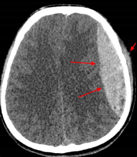 Acute Epidural Hematoma