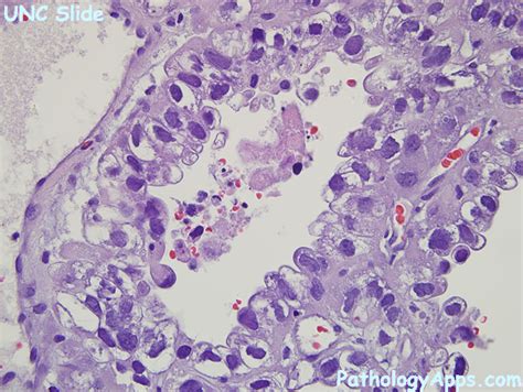 endometrial clear cell carcinoma pathology