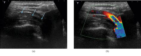 Upper-extremity deep vein thrombosis related to central venous port systems implanted in cancer ...