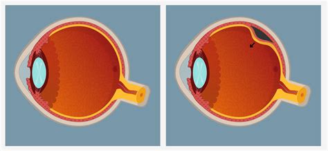 What is Retinal Detachment and How to Treat It