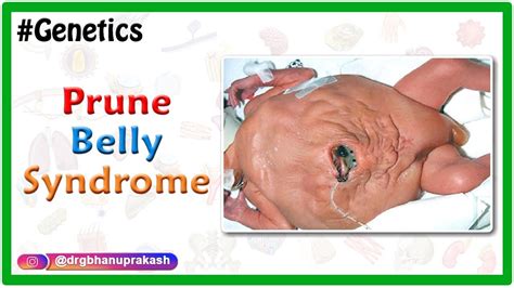 Prune belly syndrome / Eagle-Barrett syndrome - Usmle step 1 - YouTube