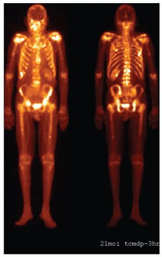 Bone Scintigraphy | Radiology Key