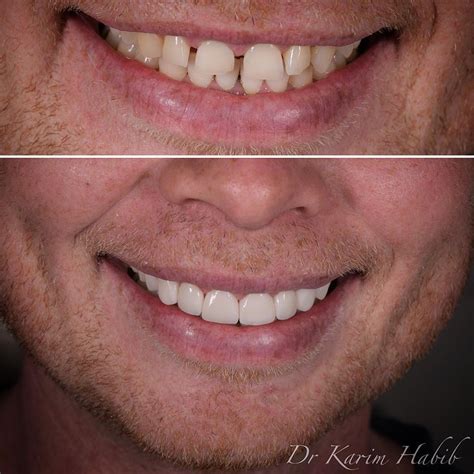 Porcelain Veneers Sydney | Best Composite Dental Veneers Sydney ...