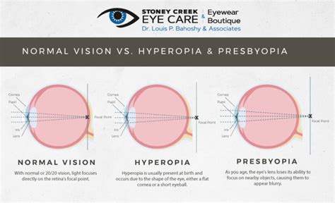 Everything You Need to Know About Presbyopia | Stoney Creek