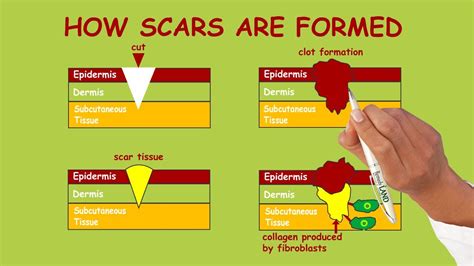 How Scars are Formed - YouTube