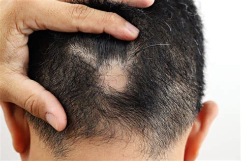 What Are the Early Signs of Alopecia? - Professional Surgical ...