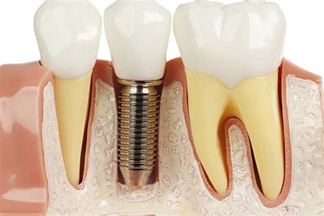 Dental Implant Care Tips | Port Coquitlam Dentist