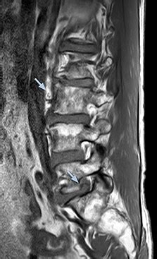 MRI nerve visualization informs surgery | FieldStrength | Philips