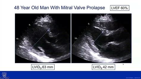 Normal Mitral Valve Echo