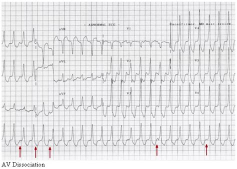 Dr.Proxy: Ventricular Tachycardia: Treatment & Medication