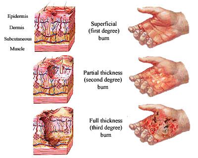 A Burn Affecting Only the Epidermis Is a - Jaylene-has-Simon