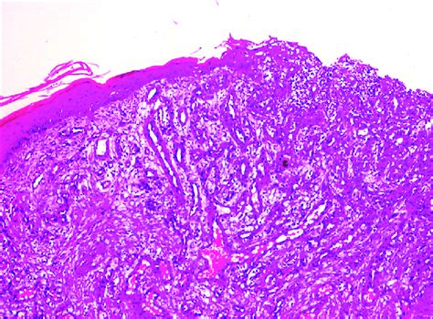 Epithelial morphology showing atrophic to ulceration seen predominantly... | Download Scientific ...