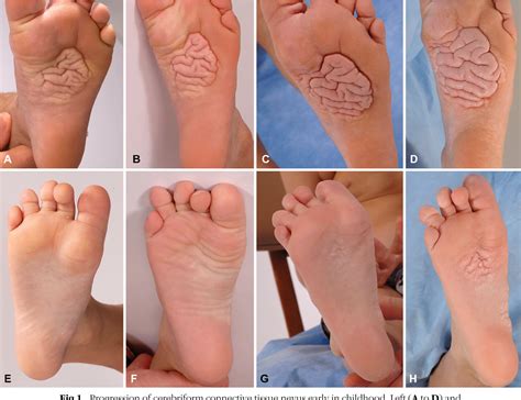 Figure 1 from Progressive overgrowth of the cerebriform connective ...