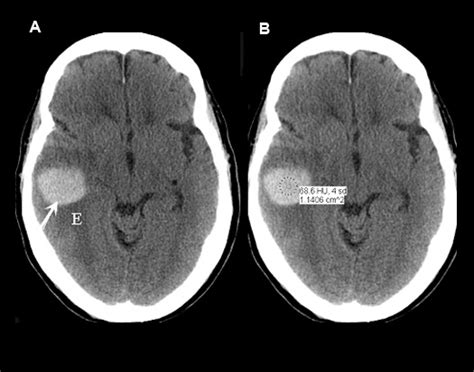 intracranial Hemorrhage