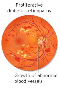 Diabetic Retinopathy and Treatment - Proliferative Retinopathy