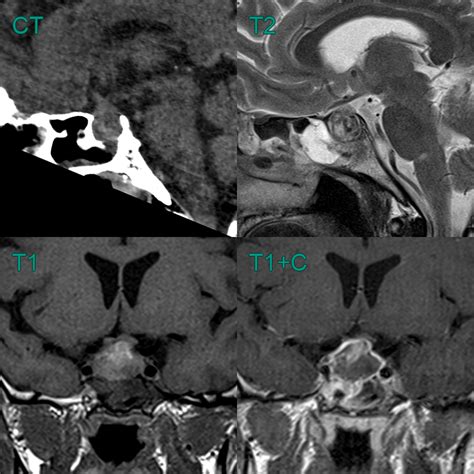 Pituitary apoplexy - NEURORADIOLOGY