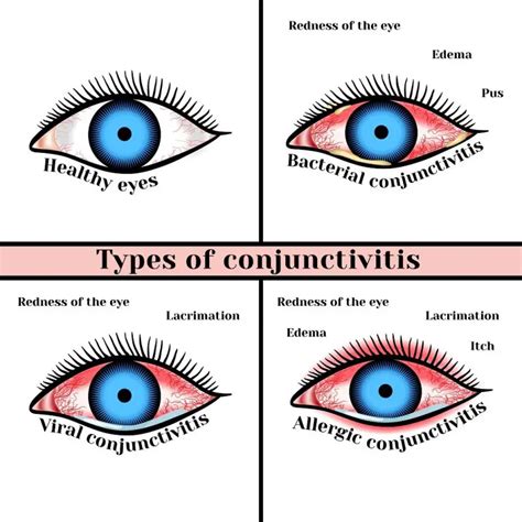 Viral Eye Infection: Types, Symptoms, Treatment | STD.GOV Blog