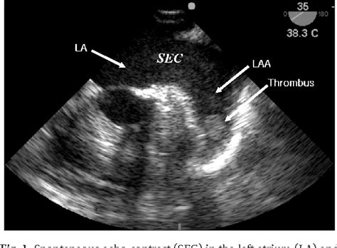 [PDF] Left atrial appendage thrombus detected by intraoperative ...