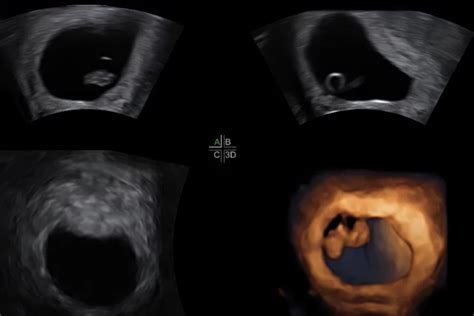 6 Week 3D Ultrasound - What to Expect | A Full Guide