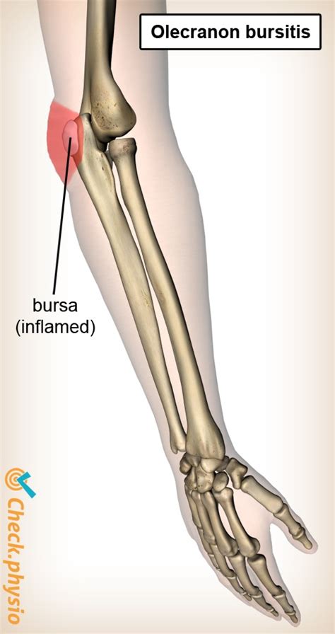 Olecranon bursitis | Physio Check