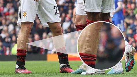 Man Utd fans just noticing 'gnarly' scar on Luke Shaw's leg from horror double break as they ...