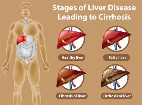 Liver Cirrhosis Final Stages