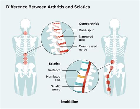 Osteoarthritis Back