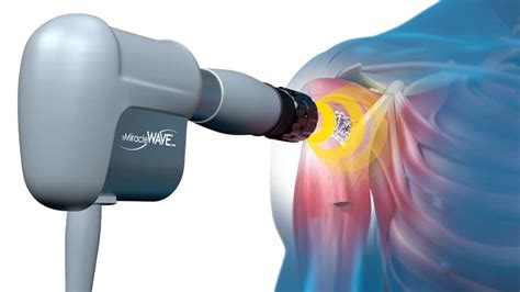 Acoustic Shockwave Therapy Miracle Wave - FYZICAL Therapy & Balance Centers