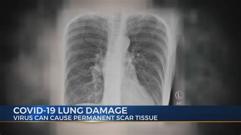 Permanent Lung Damage From COVID-19 | WTTV CBS4Indy