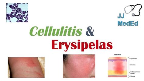 Cellulitis vs Erysipelas | Bacterial Causes, Risk Factors, Signs and ...