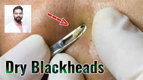 Cystic Acne Treatment, Acne Removal And Blackhead Extraction On Face _ With Relaxing Music - YouTube