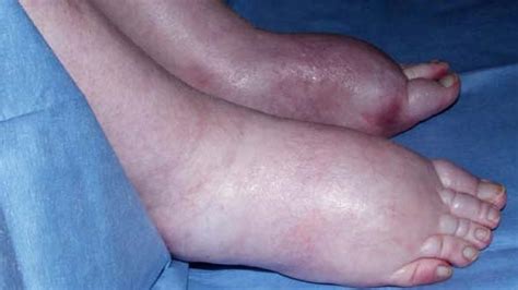 Edema Causes Swelling Generally In What Area