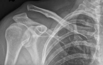 Acromioclavicular (AC) Joint Injuries