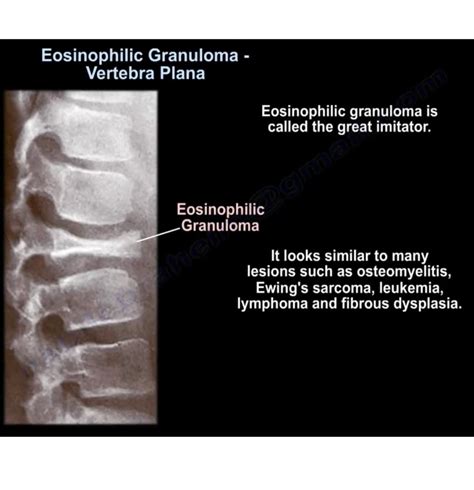 Eosinophilic Granuloma — OrthopaedicPrinciples.com