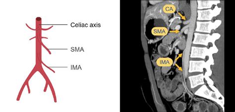 Abdominal CT: abdominal arteries • LITFL • Radiology Library