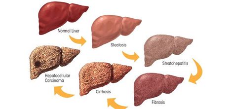 Alcoholic Liver Disease treatment | Dr. kiran peddi