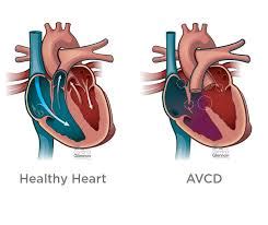 Atrioventricular canal defect surgery cost in India