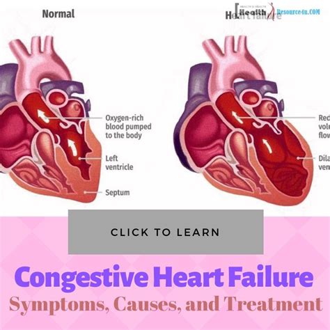 Congestive Heart Failure : Symptoms, Causes, And Treatment