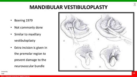 Vestibuloplasty- ridge extension procedures