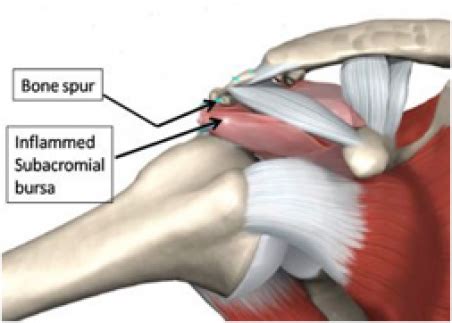 MYO Therapy & Healthcare Institute: Rotator Cuff Tears