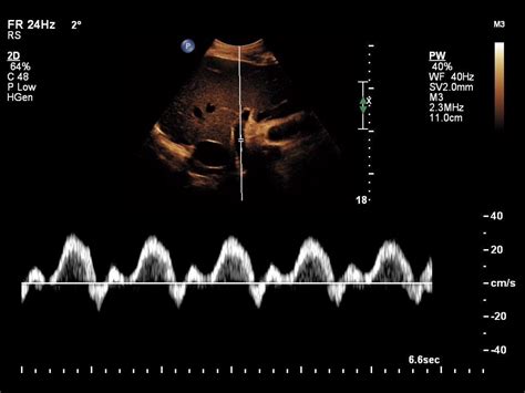 Liver Doppler Ultrasound - Pulsatility in Portal Vein Flow — @swissnephro