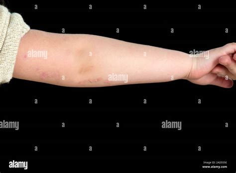 Inflammatory linear verrucous epidermal naevus (ILVEN) on the arm of a ...