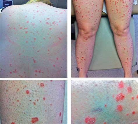 A rash after streptococcal infection | Cleveland Clinic Journal of Medicine