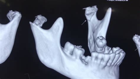 Bilateral High Sub Condylar Mandibular Fracture treatment - YouTube