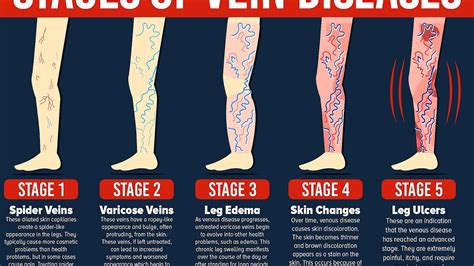 Treatment For Veins On Legs - Treat Choices