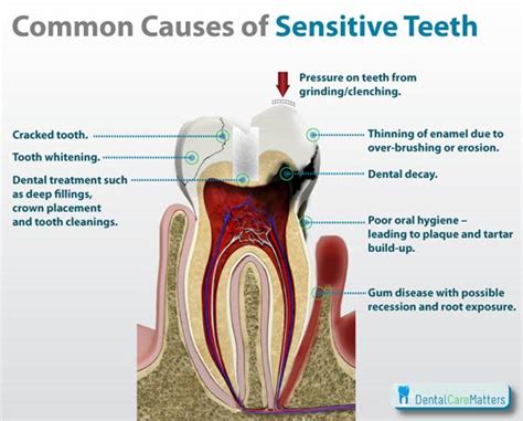 sensitive-teeth-treatment-causes - All Smiles Dent Spa