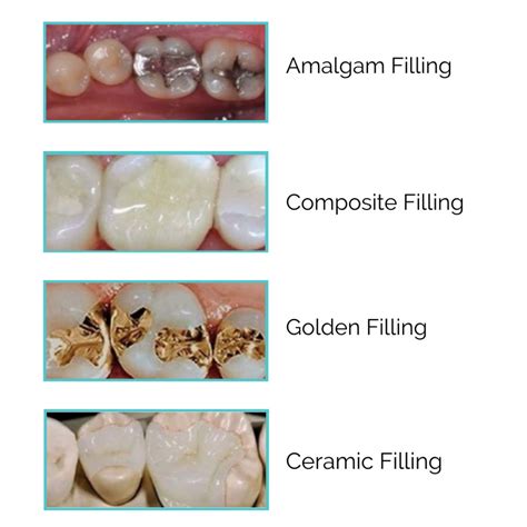 Tooth Filling | Stop Tooth Decay | Longevita