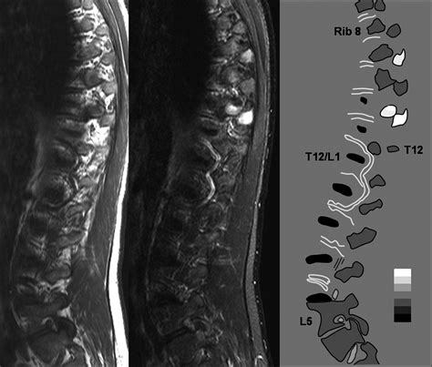 Active Inflammatory Lesions Detected by Magnetic Resonance Imaging in ...